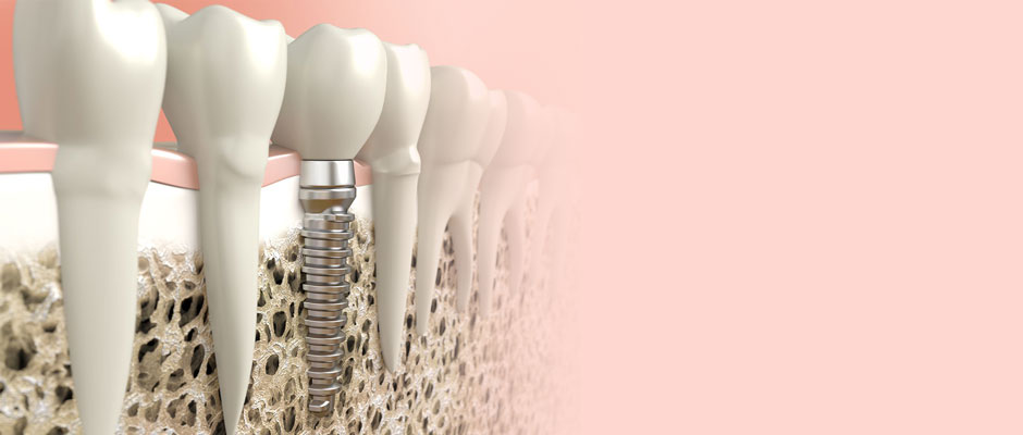 Dental Implants